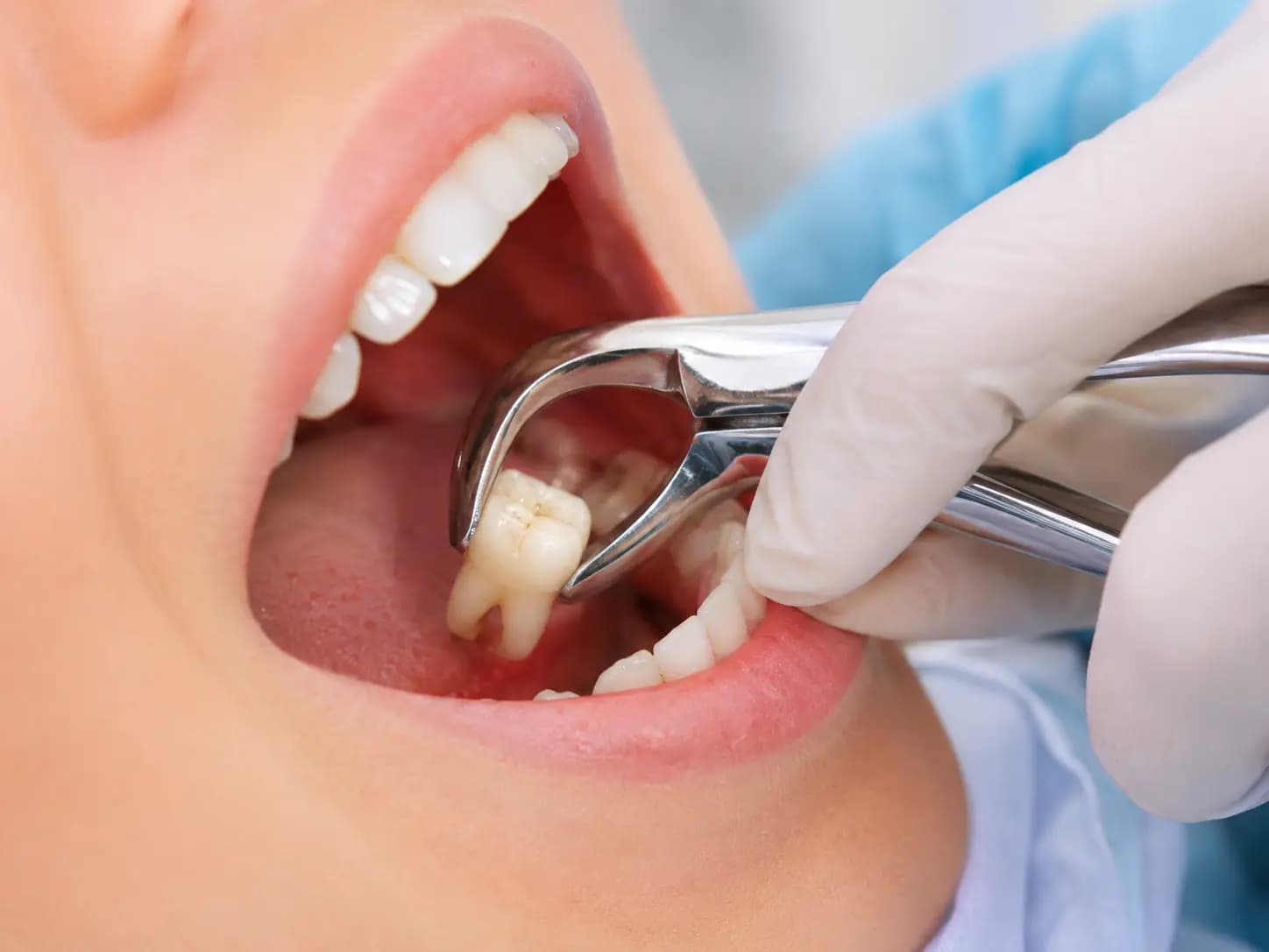 Procedimiento profesional de extracción dental